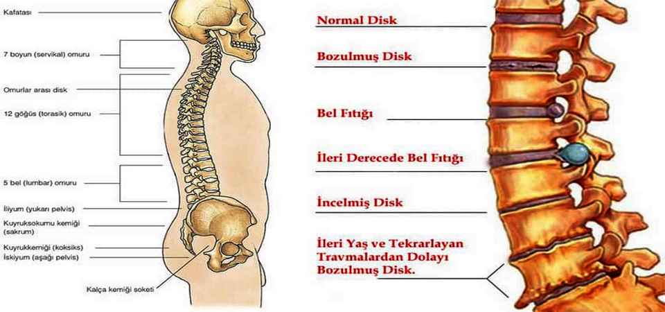Bel fıtığından kurtulmak mümkün mü?